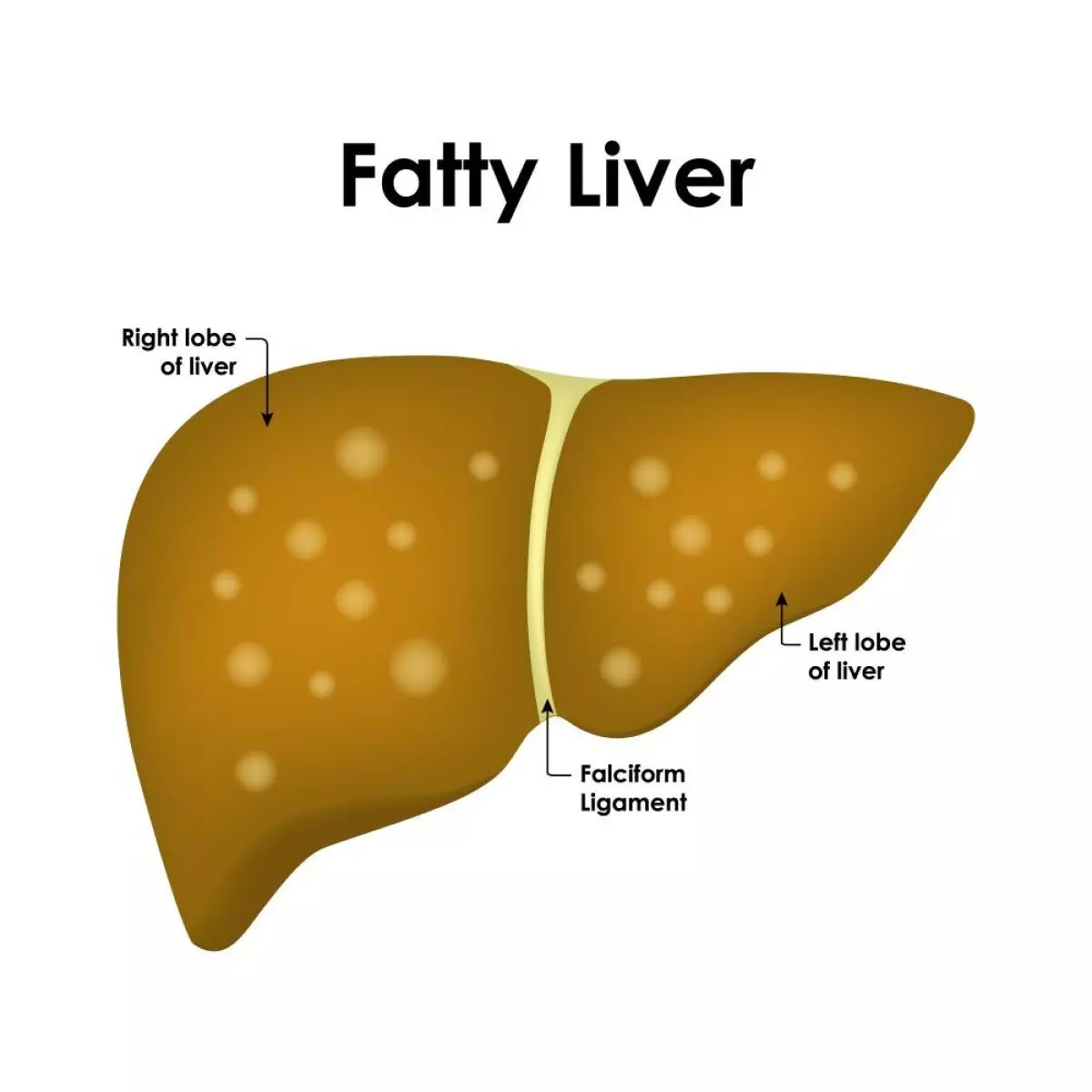 Common heart meds may reverse early fatty liver buildup Common heart meds may reverse early fatty liver buildup